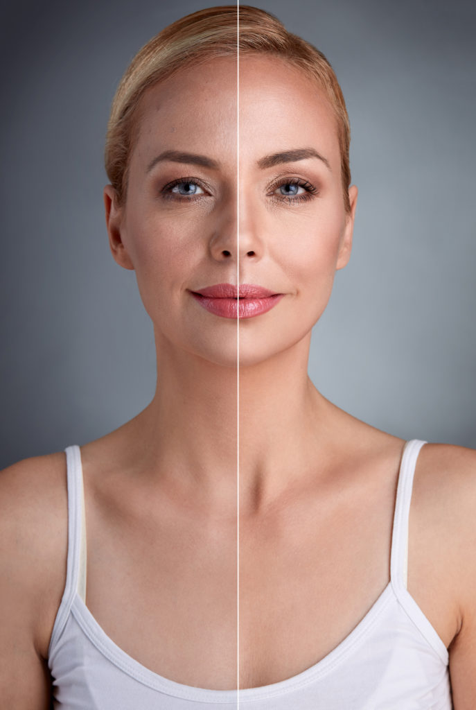 ultherapy, ultherapy blog, dr eunice park, long island, ny